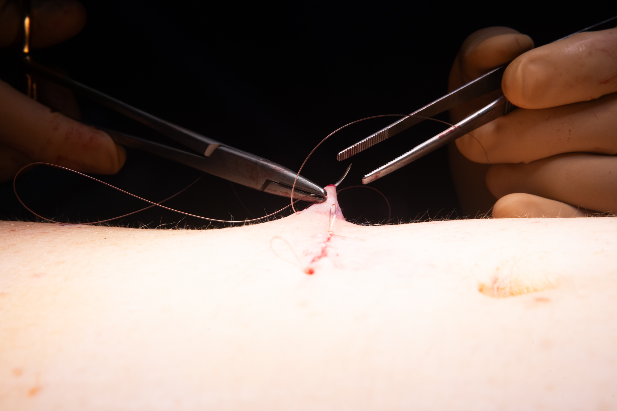 Photo suture chirurgicale hôpital Montpellier 